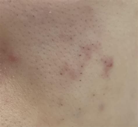 Blackheads On Cheeks
