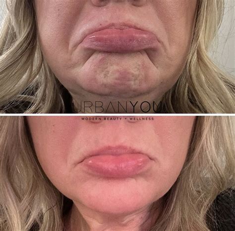 Botox for Jaw Pain and TMJ Relief — Urban You - Modern Beauty + Wellness