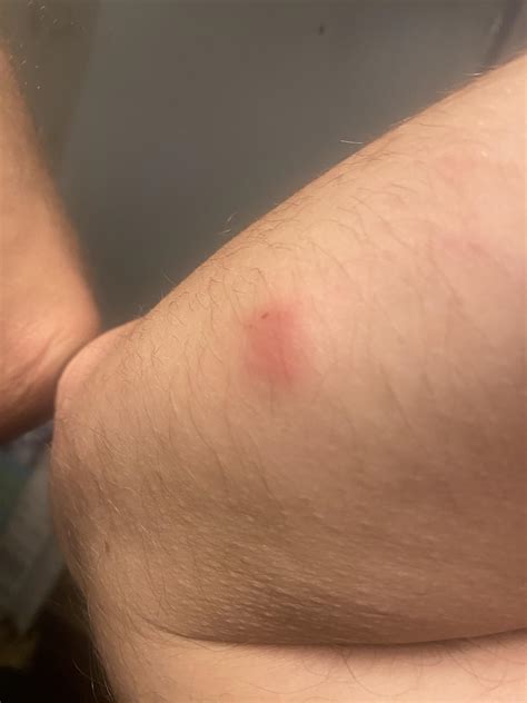 Was bitten by an assassin bug nymph last week. There was nothing at ...