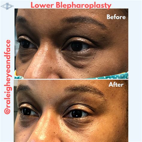 Raleigh Eye and Face Plastic Surgery - Raleigh Eye and Face Plastic Surgery - Serving Raleigh ...
