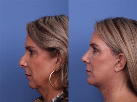Facelift Before and After Pictures Case 457 | Scottsdale & Phoenix, AZ | Hobgood Facial Plastic ...