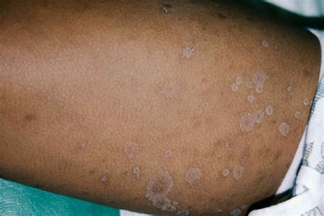 Pityriasis Rosea Contagious