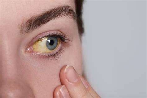 Yellow eyes: 11 main causes (and what to do)