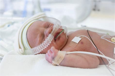 Home Oxygen Therapy For Neonates at Robin Clark blog