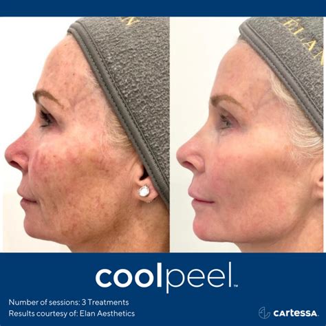 CoolPeel CO2 Laser Resurfacing Treatment in Jacksonville, Florida | Hello Smooth Med Spa