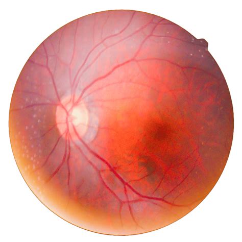 Vitreoretinal l Retina Specialists of Indiana