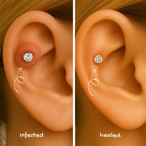 Piercing Bump vs Keloid? How to Tell the Difference & What to Do About ...