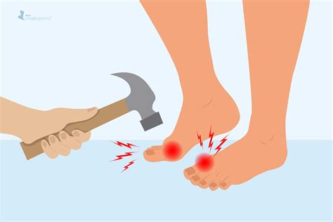 What Does Gout Pain Feel Like? Understanding Gout Symptoms