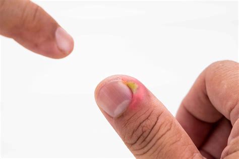 How To Draw Infection Out Of A Finger