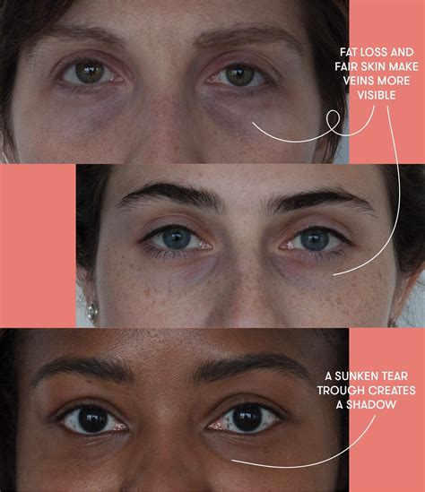 Puffy Eyes, Dark Circles, and Bags: Dermatologists Explain the Difference | Puffy eyes, Dark ...