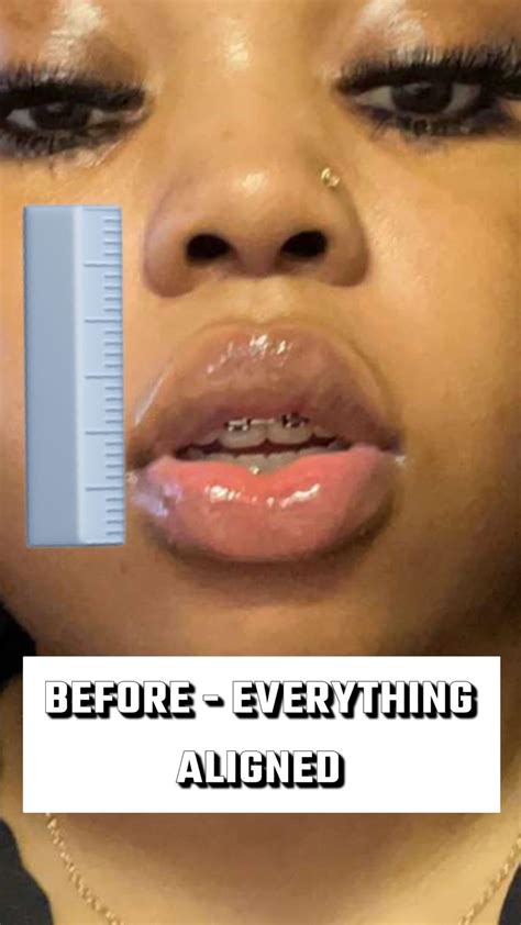 Jaw surgery ruined my face (before/after) : r/jawsurgery