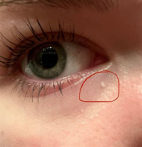 White Bump On Face I Have A Spot Or Bump On The Nose What Could It