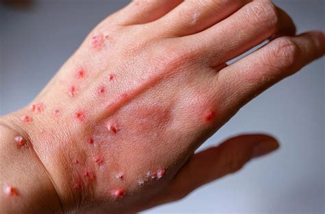 Three new Mpox cases confirmed in Barbados - nationnews.com