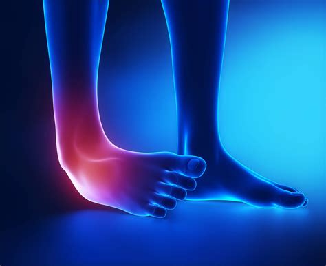 ¿Qué Es Un Esguince De Tobillo De Segundo Grado? – MCCBLX