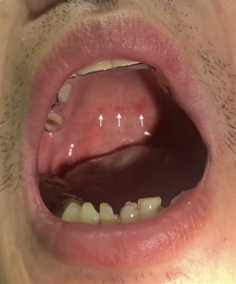 Red Spots on Soft Palate: An Atypical Peripheral Sign of Infective ...