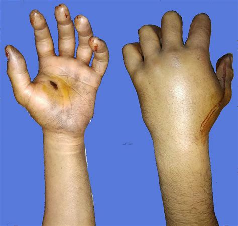 High-pressure chemical injection injury to the hand: usually ...