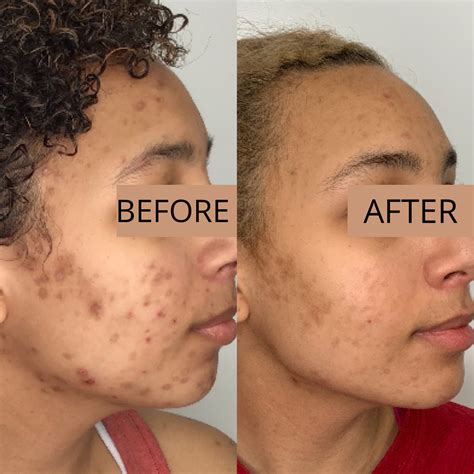 Chemical Peel For Acne Scars And Discoloration at Harriet Ridgeway blog