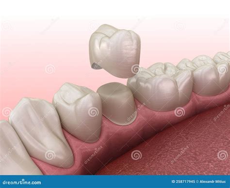 Dental Crown Placement Pain at Willard Decker blog