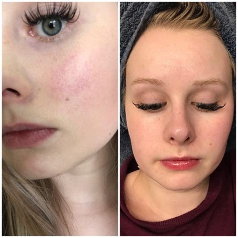 List 92+ Pictures Pictures Of Over Exfoliated Skin Superb