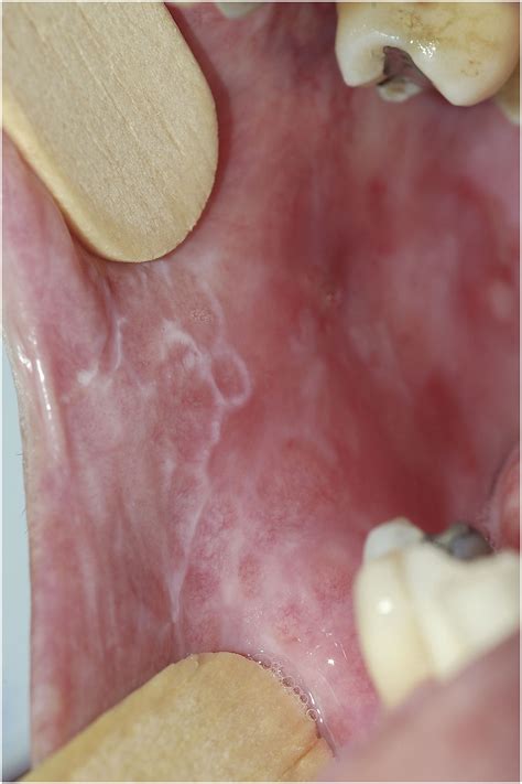 Oral Lichen Planus Images — Dermnet – FIHIDU
