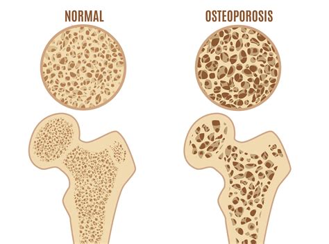 Can Osteoporosis Be Reversed? No, But You Can Prevent Bone Loss | Woman ...