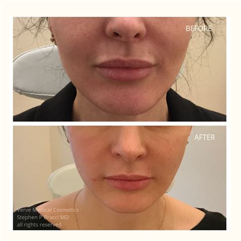 How Much Botox For Nasolabial Folds at Monica Baker blog