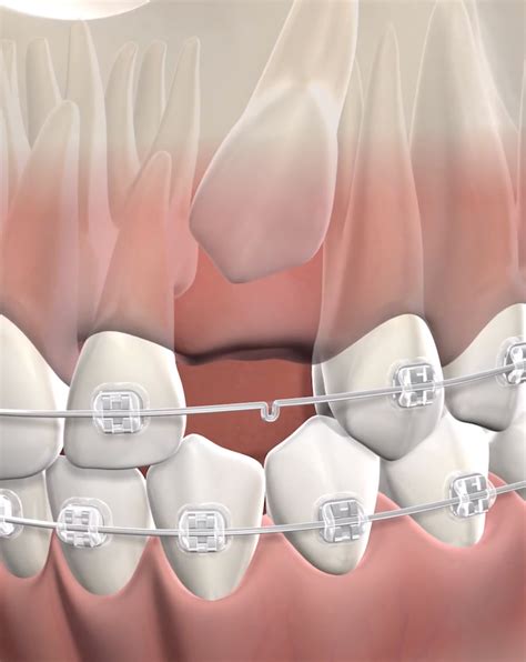 Impacted Canines in Aliso Viejo, CA | OC Oral Surgery
