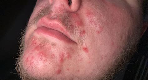 Any advice for acne around nose/mouth area? Routine was a facial toner ...