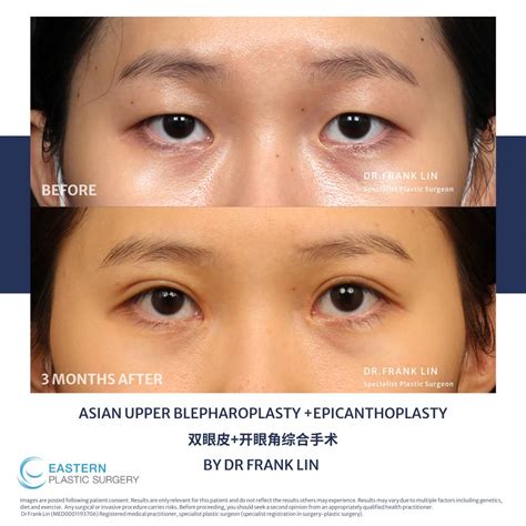 What are double eyelids sales