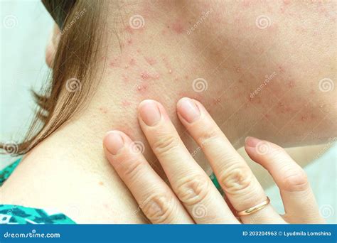 Purulent Rashes on the Neck of Woman. Allergy, Acne Stock Image - Image of neck, facial: 203204963