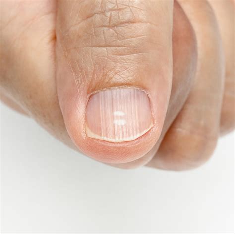 HT9. If You Notice These Lines on Your Nails After 40, Here’s What It ...