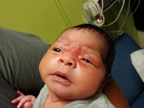 Newborn’s rash involves eyes and nose