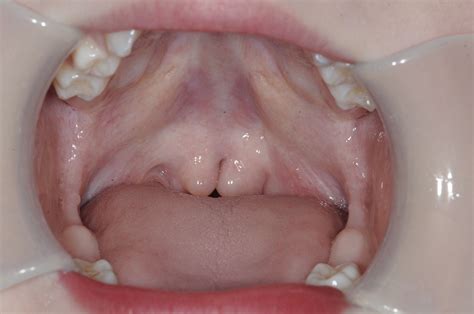 What Does A Cleft Palate Look Like at Isabelle Rivers blog