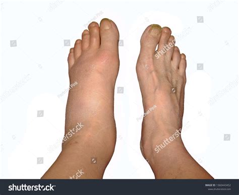 Fractured Ankle Vs Sprained