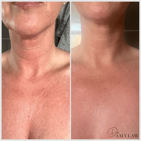 Sun Damaged Chest Treatment in Liverpool | Dr Amy Law