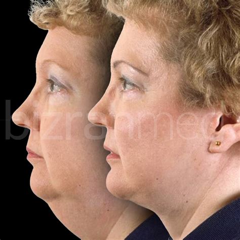 Cosmetic Surgery for Ageing: Enhancing Natural Beauty with Double Chin Removal | Bizrahmed