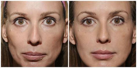 Pin by Beth Domolky on natural looking injectables | Sculptra, Lip fillers, Lip art makeup