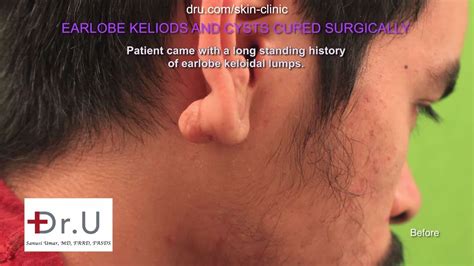 Painful Cyst Behind Ear