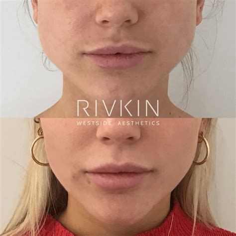 Non Surgical Jaw Reduction - RIVKIN Aesthetics