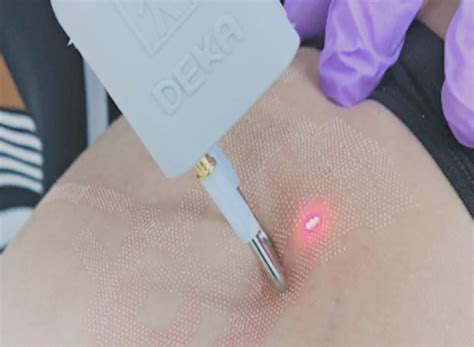 Non Cancerous Lesions Skin - Benign Growth on Skin | rtwskin