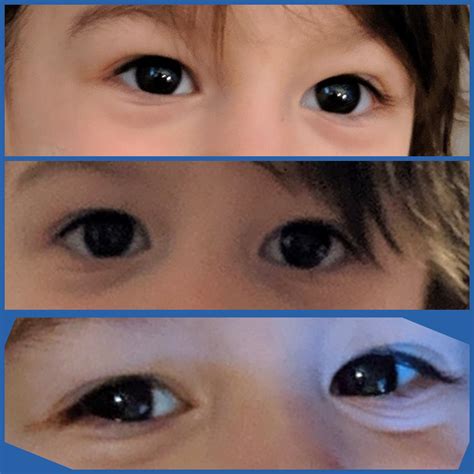 Epicanthal Folds Vs Normal