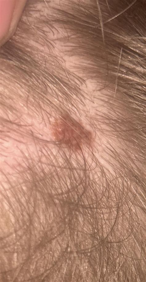 Mole on scalp : r/DermatologyQuestions