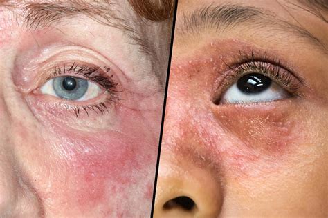 Seborrheic Eczema Face