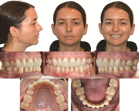 Progressive idiopathic condylar resorption: 6-year update - AJO-DO Clinical Companion