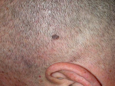 Skin Cancer Scalp