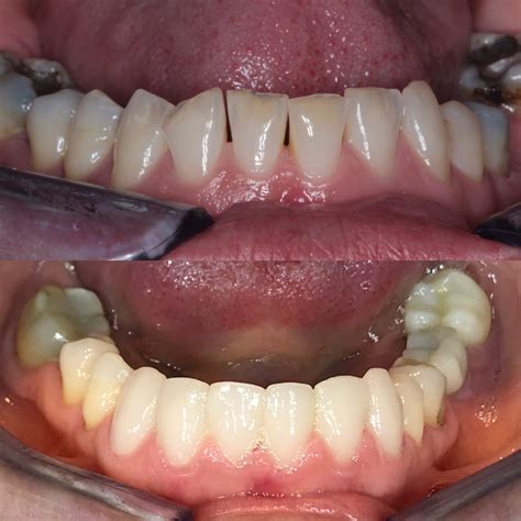 Dental Bonding On Lower Teeth at Jennifer Quevedo blog