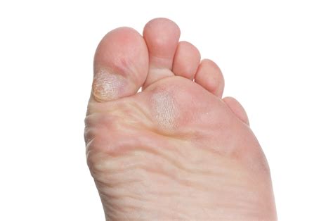 Plantar callus: Throw the kitchen sink at it | Foot Problems?
