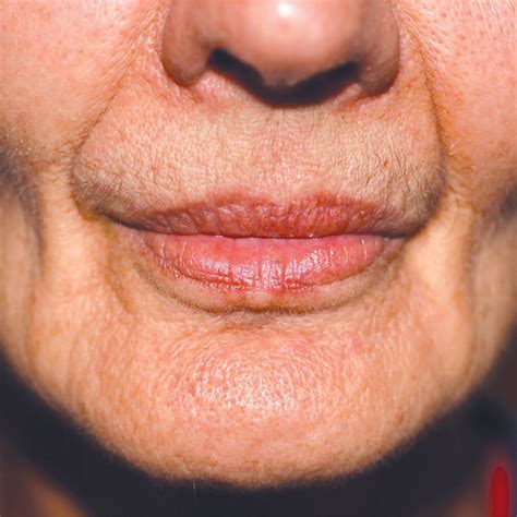 Loss of Facial Volume Treatment in Singapore: Cheeks & Under Eyes