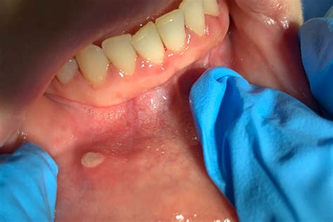 Llagas bucales. Causas y tratamiento - Menedent