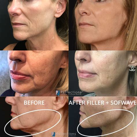 Jawline Contouring 🥇 Los Angeles Non Surgical Jawline Contouring